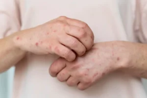 Natural remedies for chickenpox relief including soothing creams and herbal treatments