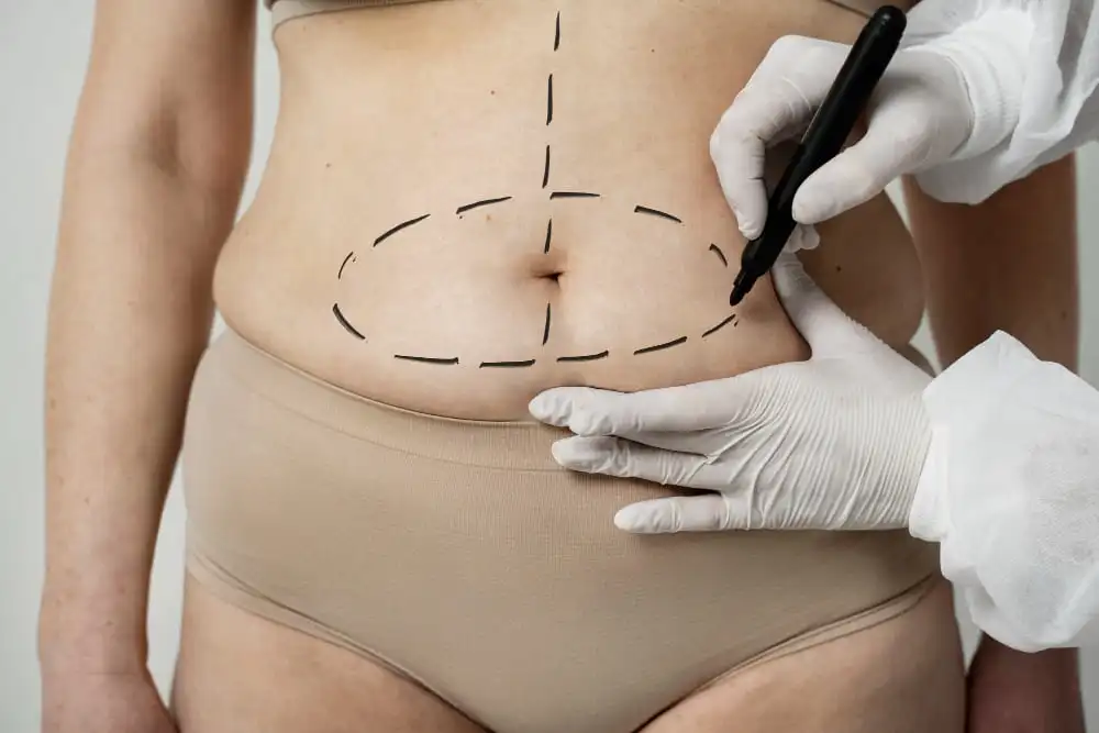 Essential benefits of liposuction results with key recovery tips